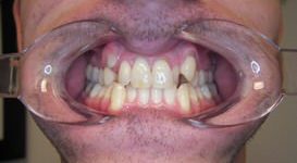 Teeth Before Braces