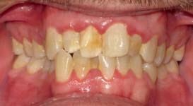 Teeth Before Braces