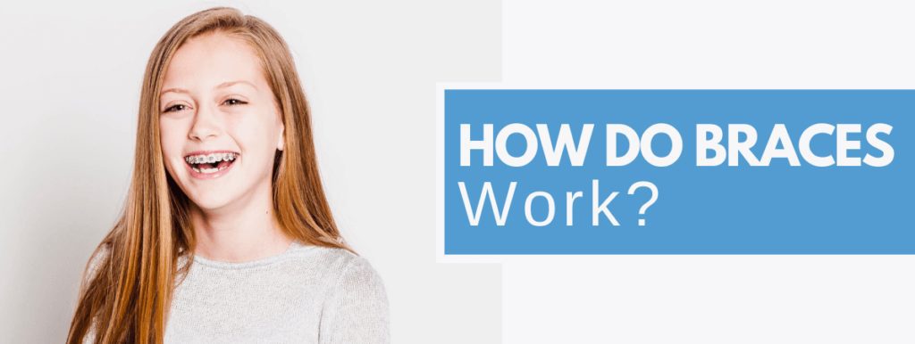 how do braces work